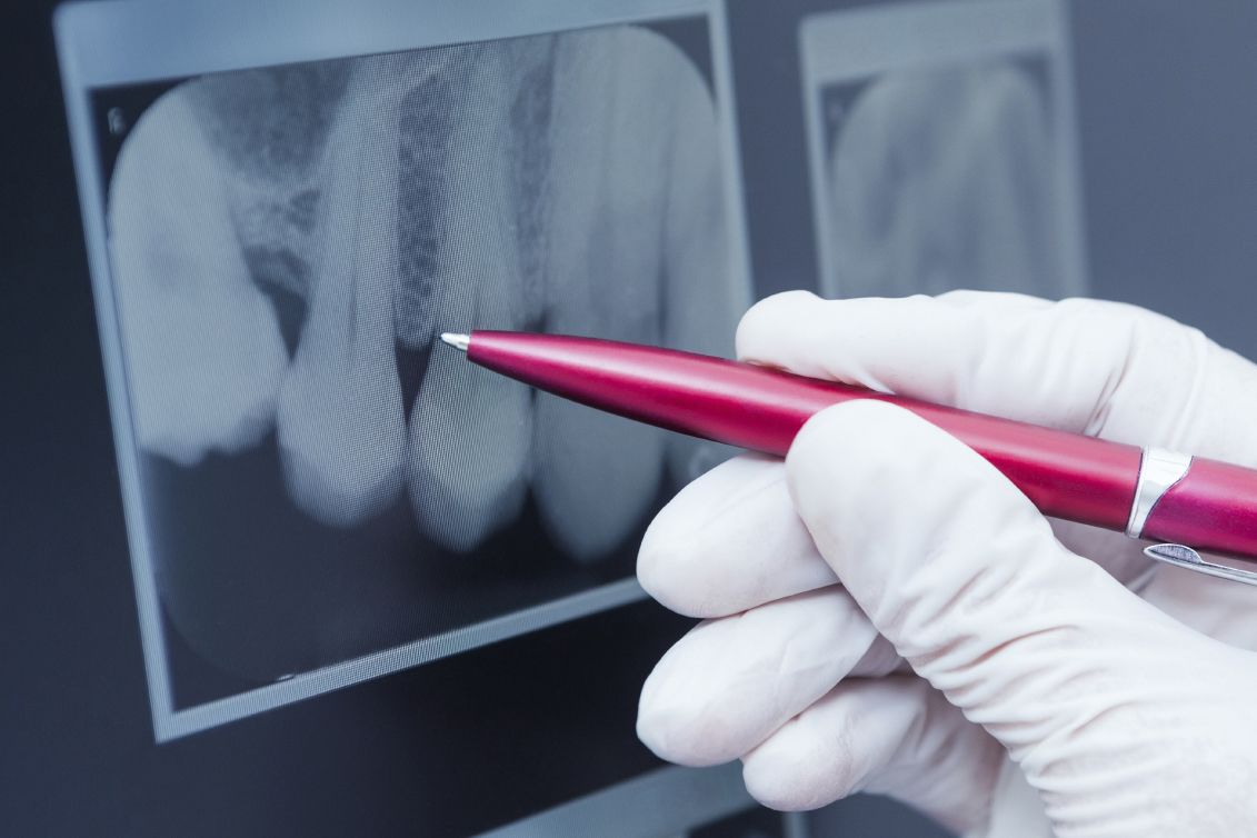 Photo of a pen pointing at a dental x-ray