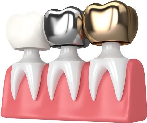 Porcelain, silver, and gold crowns