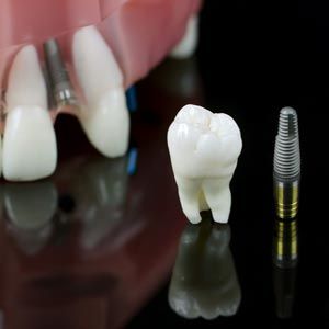 tooth and implant