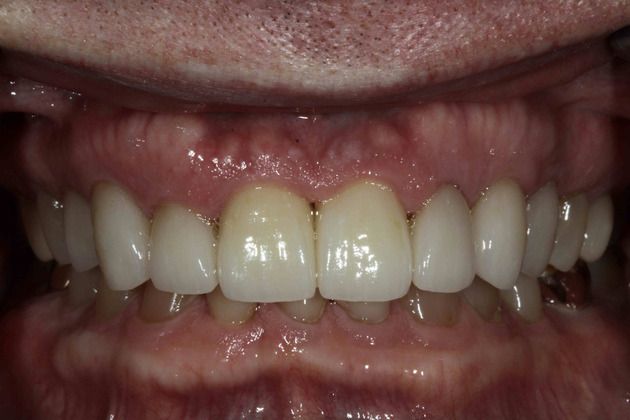 After Implants