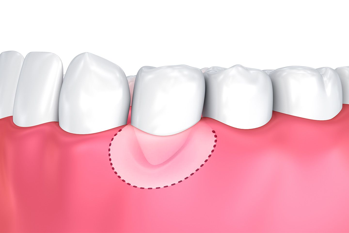 Illustration of gum grafting